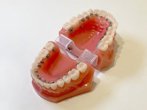 裏側矯正　歯の模型