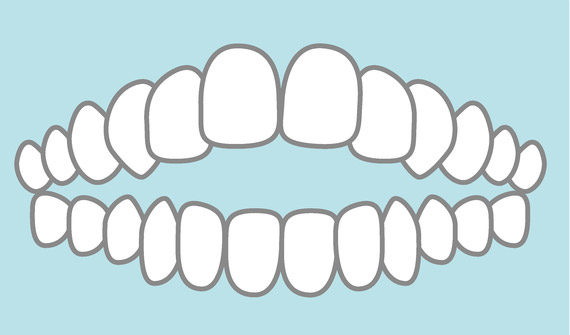 開咬　オープンバイト 放置すると　矯正