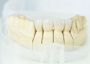歯　セラミックのイメージ画像