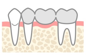 ブリッジ　仮歯　矯正