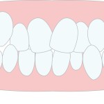 ガチャ歯　悪い歯並び 歯が凸凹　部分矯正