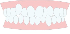 歪んだ歯並び種類 歪む原因　矯正治療