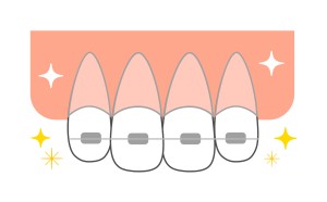 矯正中の歯の動き 矯正中