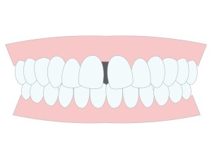 正中離開　すきっ歯 歯の隙間矯正