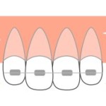 部分矯正　矯正治療 矯正期間