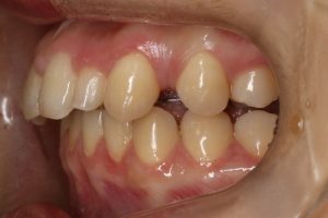 歯のすき間
