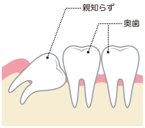 親知らず　抜歯　矯正