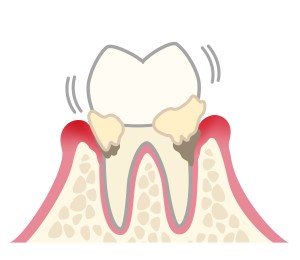 歯ぎしり悪影響 歯周病