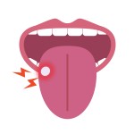 口内炎と歯並び関係 矯正治療　口内炎