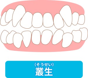 八重歯　叢生　前歯の凸凹