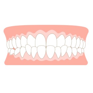 受け口　上あごとの関係　 反対咬合　しゃくれ