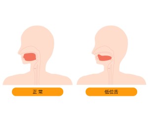 歯並び以外の滑舌悪い原因　舌　低位舌　筋力低下