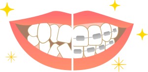 乱杭歯　歯並び凸凹 ガチャ歯　矯正治療