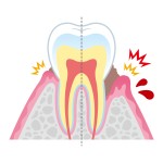 歯根吸収　矯正　歯がぐらつく　歯列矯正