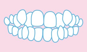 ねじれた歯並び 凸凹歯並び　叢生