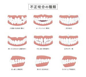 不正咬合　過蓋咬合　切端咬合　受け口　噛み合わせ