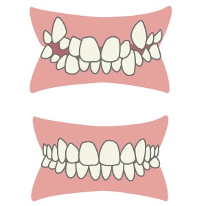 八重歯　凸凹　犬歯上から歯が生えている