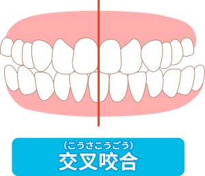 交差咬合とは　歯並び 凸凹　ズレた歯並び　矯正