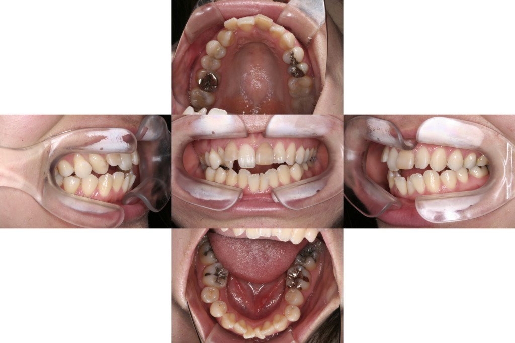 case11_開咬_初診