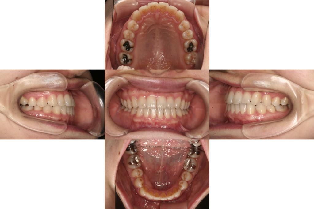 case12_軽度反対咬合_1年10ヶ月