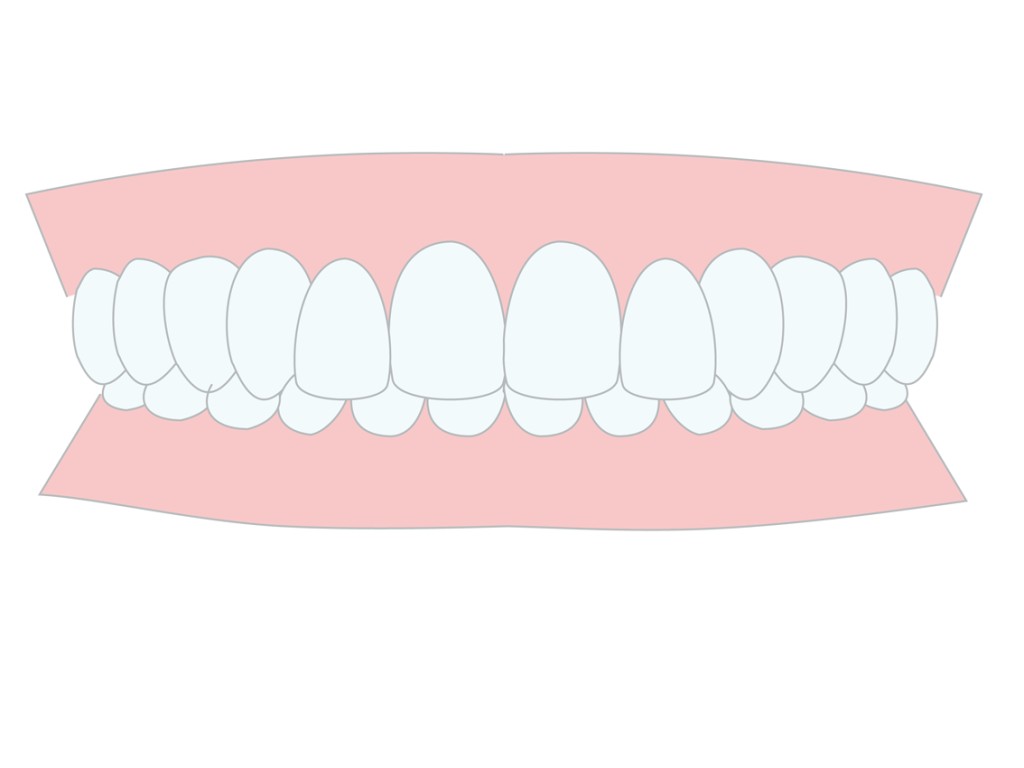噛み合わせが深い　過蓋咬合　前歯がぐっと下がっている