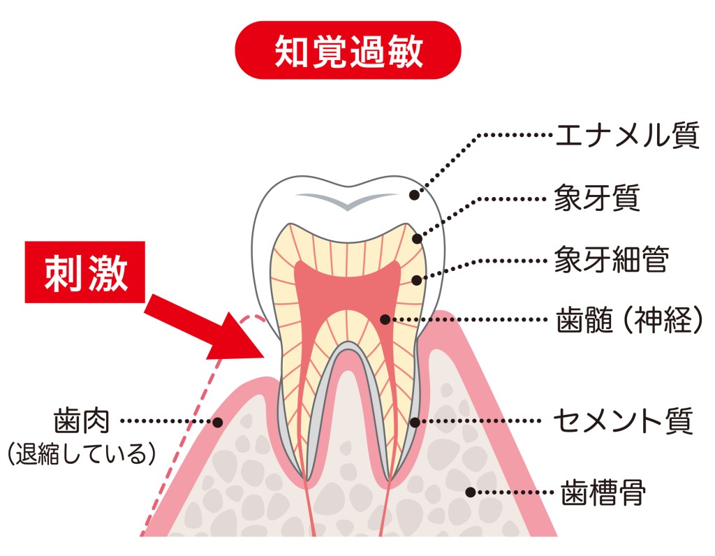 歯が痛い　知覚過敏　歯ぎしり　親知らずの影響